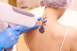 laser tattoo removal by Embrace MGT in Torrance, CA