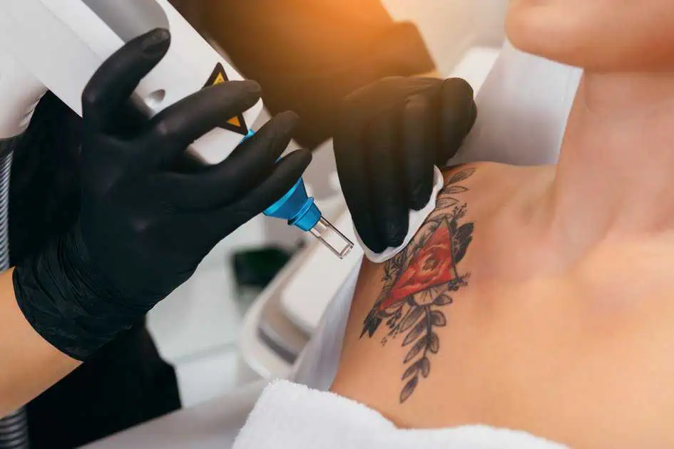 Laser Tattoo Removal by Embrace Med Spa in Torrance CA