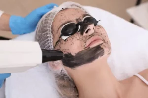 Carbon Laser Facial by Embrace MGT LLC in Torrance-CA