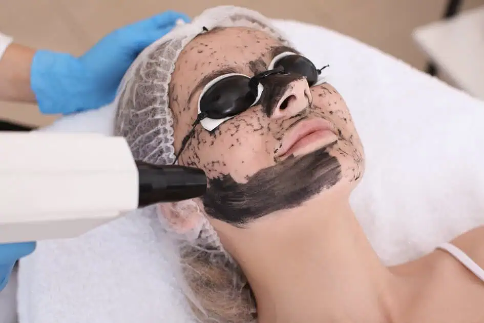 Carbon Laser Facial by Embrace MGT LLC in Torrance-CA